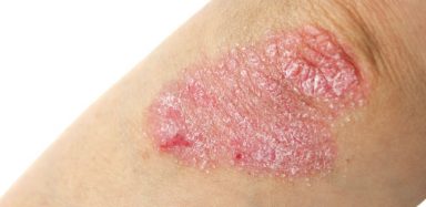 Psoriasis on the elbow.