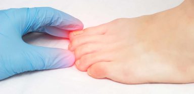 A doctor wearing a blue latex glove holding someone's toe that's infected with fungus.