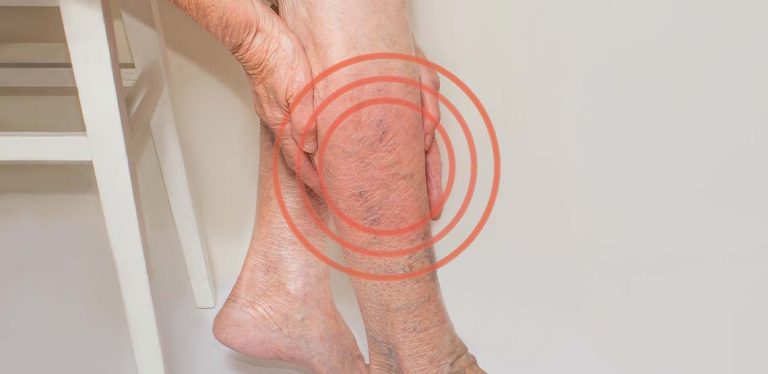 A person's leg with varicose veins and eczema.