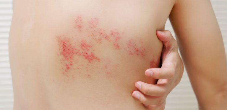 A person's back, covered in the shingles virus