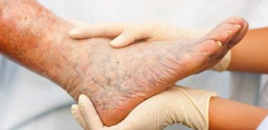 foods for varicose veins