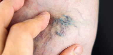 varicose veins cancer symptoms